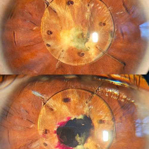 Before and after eye surgery