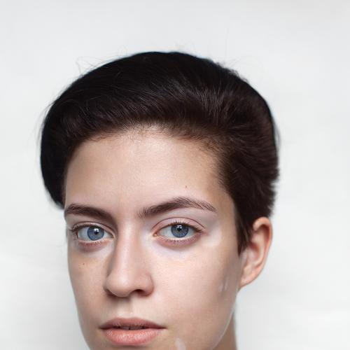 Vitiligo