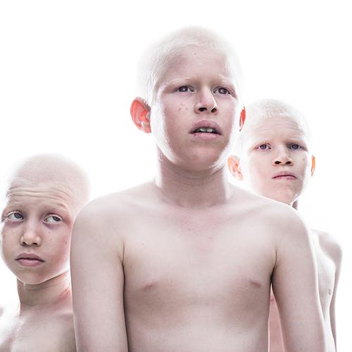 Albinism in India